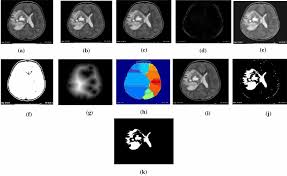 Time how long the seizure lasts so you can tell the paramedics. Simulation Result Of Benign Brain Tumor Image A Tumor Affected Mri Download Scientific Diagram