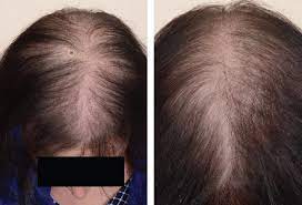 However, this treatment fails to achieve hair regrowth in some patients. Male And Female Pattern Hair Loss Treatable And Worth Treating Cleveland Clinic Journal Of Medicine