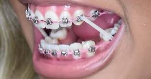 Elastics Powerchain Braces Girlswithbraces Teeth Braces Braces Colors Cute Braces Colors