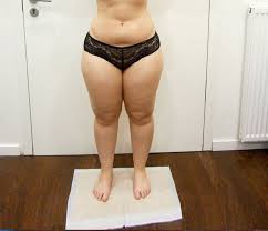 Liposuktion Mvz Westpfalz