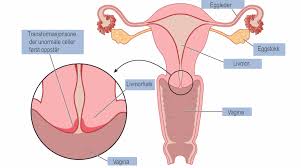 Vanligvis vil en lokal prostatakreftsvulst vokse langsomt og ikke være svært alvorlig eller gi. Livmorhalskreft