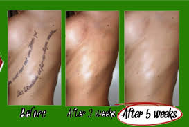 Tattoo Removal Before And After Photos