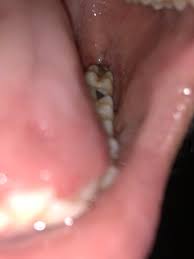 1 severe pain after oral surgery. Can Someone Tell If This Looks Like A Dry Socket It S Been 7 Days Since The Extraction And It S A Weird Ache That Comes And Goes Wisdomteeth