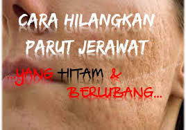 Cara hilangkan parut jerawat hitam. Cara Hilangkan Parut Jerawat Berkawah Dan Hitam Bebelsihat Com