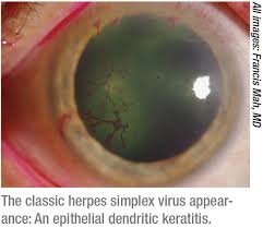 Right herpes simplex interstitial keratitis; How To Manage Ocular Herpes
