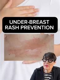 Image result for heat rash under breasts