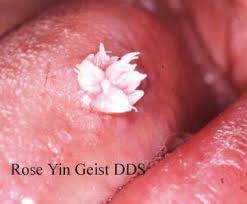 Image result for human papillomavirus symptoms