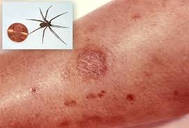 Image result for yellow sac spider bite skin