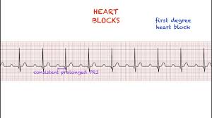 Image result for Atrioventricular Block