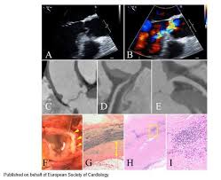 Image result for Cardiovascular Syphilis