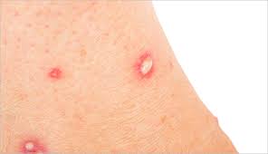 Image result for Fire Ant Sting