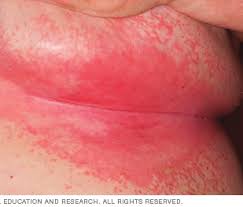 Image result for Intertrigo under breasts