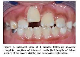Image result for Tooth Luxation