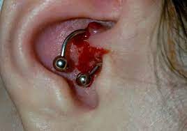 Hopeful Results 6 Months After Daith Piercing For Migraines