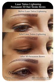 laser permanent makeup removal