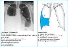 Shortness of breath is by far the most common symptom. Jaypeedigital Ebook Reader