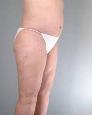 Body Thigh Lift Houston Tx Sugar Land Thighplasty