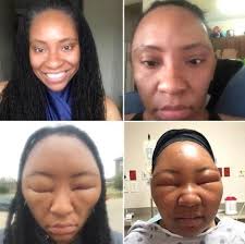 Woman Shares Photos Of Horrific Allergic Reaction To Hair Dye Which Left Her Unrecognisable Thelivefeeds Com Hair Dye Allergy Henna Hair Dyes Henna Hair