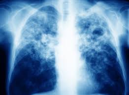 If someone in this group presents post tb skin test at what mm circumference would they be positive: The Fine Art Of Administering A Tuberculin Skin Test Clinical Advisor