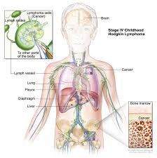 Some may have outside causes like radiation exposure, and others may. Childhood Hodgkin Lymphoma Disease Causes And Symptoms Acco