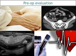 Image result for Appendicitis