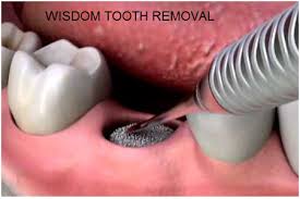 Understanding The Need For Wisdom Teeth Removal In 2020 Wisdom Tooth Extraction Wisdom Teeth Wisdom Teeth Removal