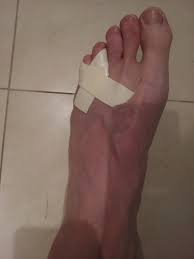Follow our at home pain relief guides, how to trim your nails properly and even how to remove them permanently. How To Splint Tape And Heal A Broken Pinkie Toe Toe Injuries Broken Toe Pinky Toe