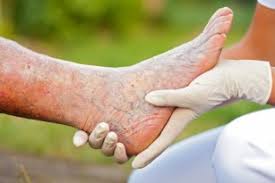 Fiziopatologia tromboflebitei profunde descrie triada virchow. Tromboflebita Superficiala