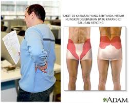 Penyakit batu karang (kidney stone) adalah masalah kesihatan yang lazim terjadi di kalangan lelaki. Kenali Penyakit Batu Karang Dan Tanda Awal Penyakit Ini