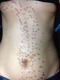 Unfortunately, you can still suffer from burns from laser hair removal. Zeina Nehme On Twitter More Disasters Burns From Hair Removal Lasers Operated By Non Professionals Laser Dermatology Http T Co Thwhy9ozxu