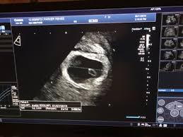 You can discuss whether you want or need a dating scan with your doctor or midwife. 6 Week Dating Scan July 2019 Birth Club Babycenter Australia