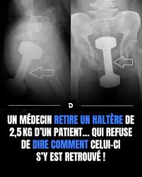Demotivateur - Un haltère de 2,5 kg a été retiré d'un patient dans un cas médical totalement inattendu. Plus surprenant encore, le patient n'a jamais expliqué comment l'objet avait pu se retrouver