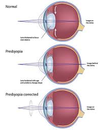 Cataracts and cloudy vision can have multiple causes. Presbyopia In Vienna Vienna Blurry Vision Correct Blurry Vision 26105