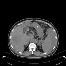 Pin On Hepatobiliary Radiology