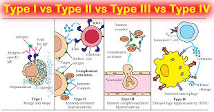 Синдром гудпастчерса, гломерулонефрит 1 типа. Hypersensitivity Type I Ii Iii And Iv In One Table Microbe Notes