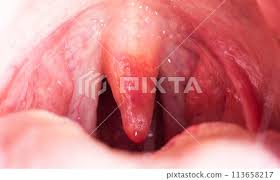Image result for Uvulitis
