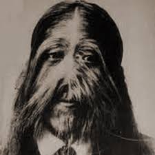 This is a condition in which people suffers from excessive hair growth on any part of. Werewolf Syndrome Archives Circus Freaks And Human Oddites