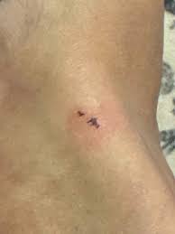 Image result for wolf spider bite skin