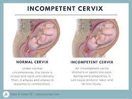 Maybe you would like to learn more about one of these? Incompetent Cervix Signs Symptoms Diagnosis Treatment