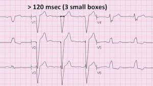 Block bundle branch 1st bbb av interval pr normal degree ecg ekg heart blocks prolonged medical ecgs indicates education therefore. Left Bundle Branch Block Youtube