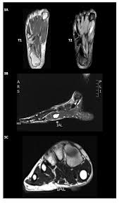 ► shoulder ► elbow ► wrist ► finger ► thumb. Diagnostics Free Full Text Intramuscular Ganglion Cyst Of The Flexor Hallucis Brevis Secondary To Muscle Tear A Case Report Html