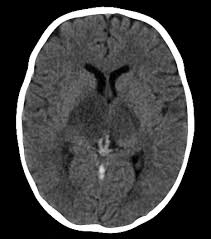 The cavernous sinus is one of the several cerebral veins and cavernous sinus thrombosis is a specific type of cerebral venous (sinus) thrombosis. Neurovascular Medicine