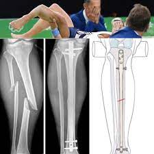 The snap of his leg could be heard throughout the venue and video of the. Pin On Olympic Games