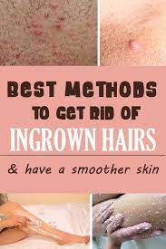 It's sometimes used to treat acne, and it may also work for ingrown hairs. 11 Remedies For Get Rid Of Ingrown Hair Ideas Ingrown Hair Ingrown Hair Remedies Hair Remedies