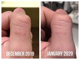 Purenature daily c is formulated with all natural ingredients. Review Vitamin C Serum Works These Two Images Were Taken One Month Apart I Missed A Few Days Here And There But Here S My Progress On An Old Scar Skincareaddiction