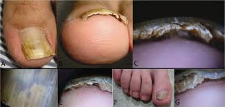 Image result for Onycholysis feet