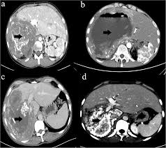 Liver cancer is not common at all in dogs and only makes up 1.5% of cancerous tumors, but it's still possible for your dog to develop cancer if you don't spot the signs of liver damage early enough. A New Treatment Strategy For End Stage Hepatic Alveolar Echinococcosis Ivc Resection Without Reconstruction Scientific Reports