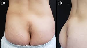 Image result for Spinal Dysraphism