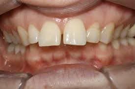 La présence du dentier dans votre je viens d'atteindre mes 83 ans et j'ai un dentier depuis 20ans. Machoire Du Bas En Retrait Et Autres Decalages Quelle Orthodontie