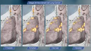 Learn more about lung cancer stages stage i prostate cancer Stage 3 Lung Cancer All That You Need To Know Scientific Animations
